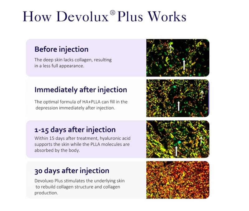 How PLLA Buttock Injections Work