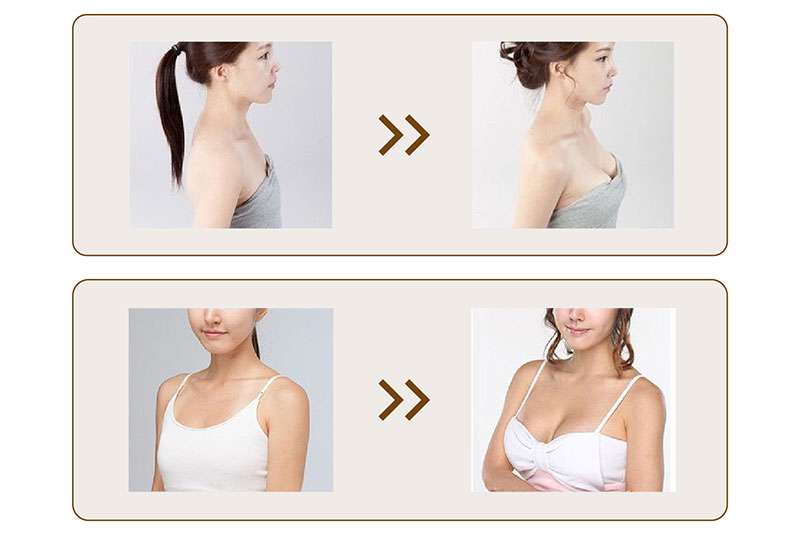 Hyaluronic acid filler for breast before and after