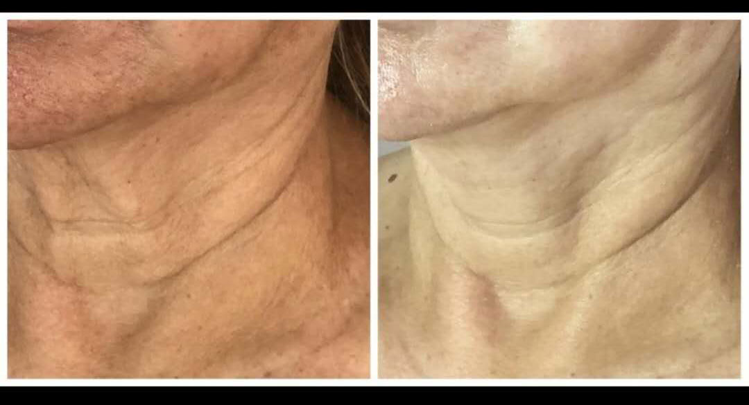 pdo smooth threads neck before and after (2)