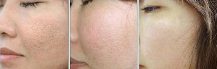 Skin texture improvement after PDRN skin booster treatment