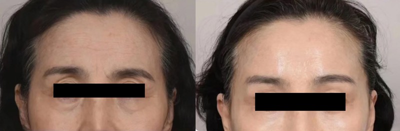 Dermal fillers for sunken eyes before and after treatment