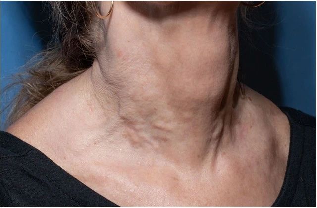 Neck nodules after calcium hydroxylapatite injection