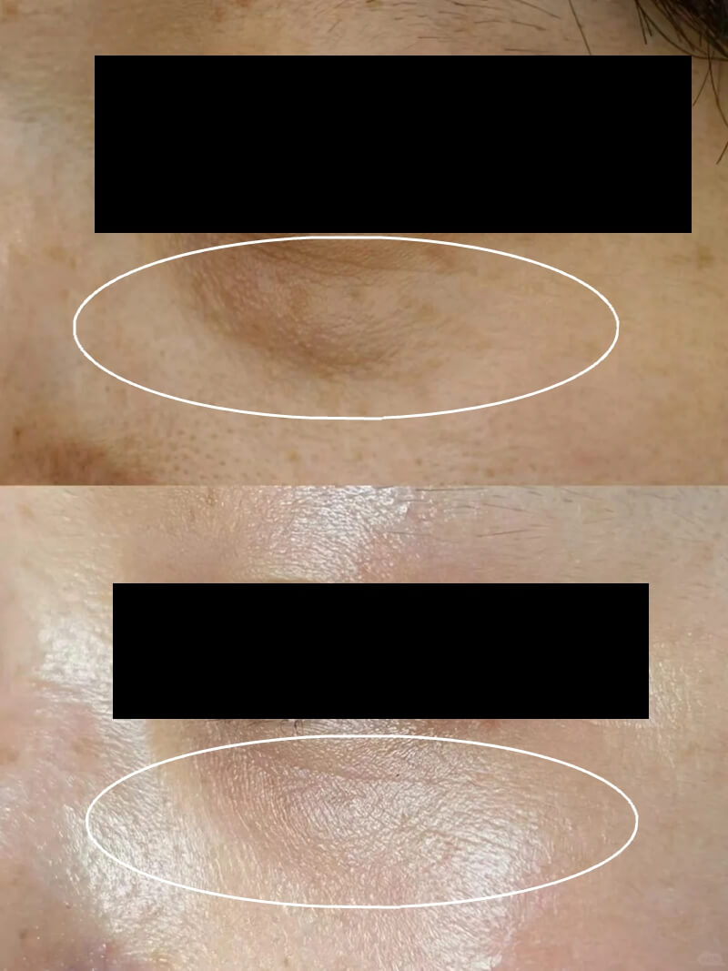 exosomes under eyes before and after