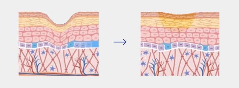 Inflammation Reduction & Barrier Repair