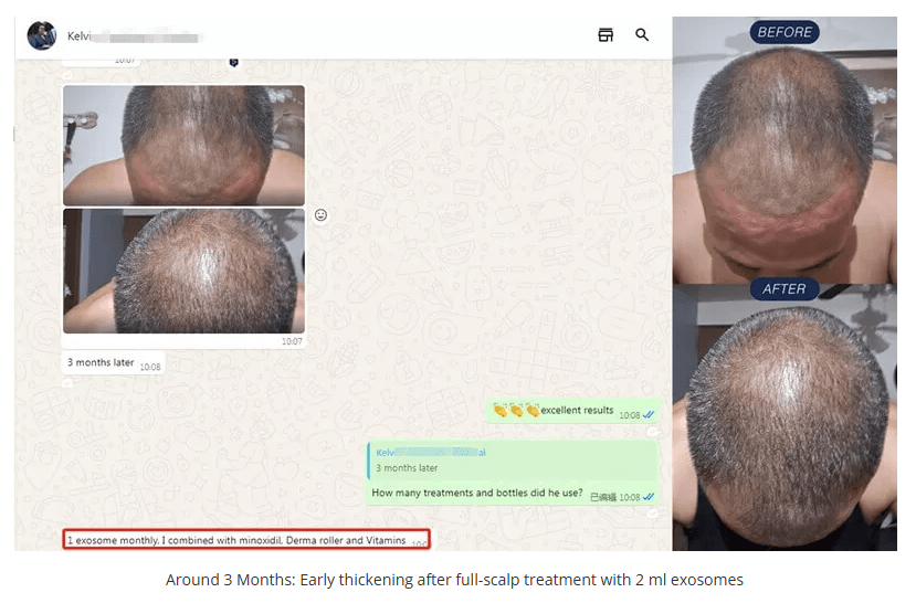 EXOBLOOM&reg; Exosome Scalp Care