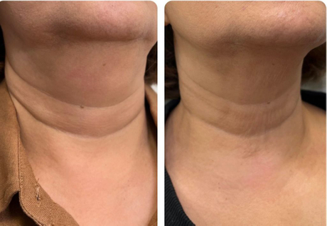 Fat Dissolving Injections Results & Effectiveness.jpg