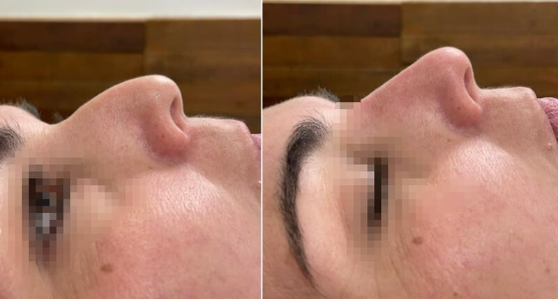 pmma before and after photos