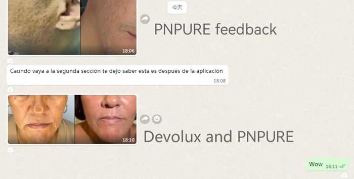 polynucleotide treatment reviews before and after