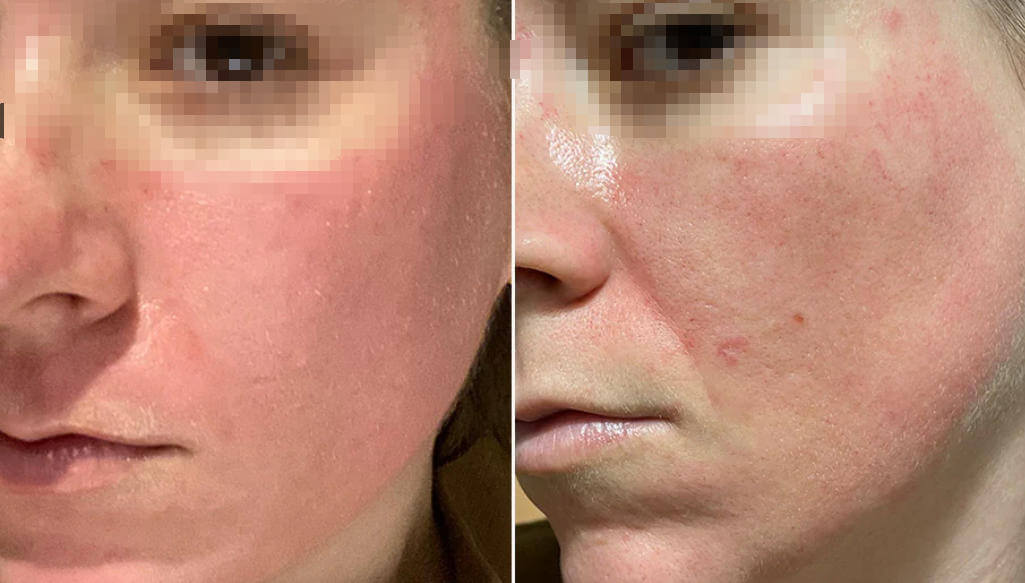 pdrn after microneedling recovery