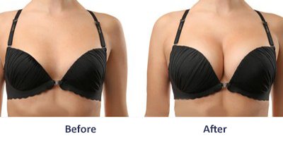 Breast enhancement