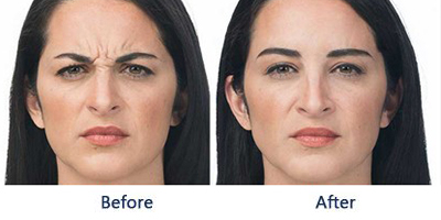 Wrinkles between the eyebrows