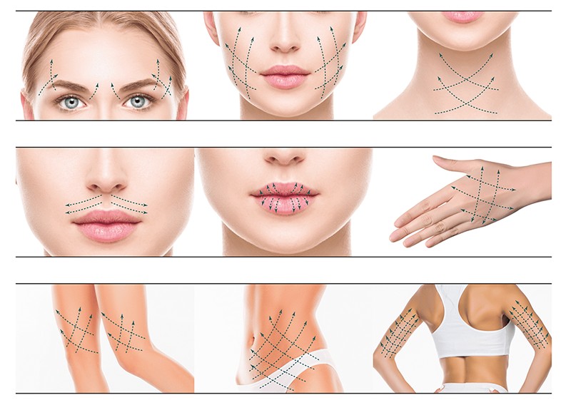 There Is a Great Demand for Non-surgical Aesthetics, Magik PDO Thread Lifts Are a New Way to Achieve Instant Skin Tightening (4)