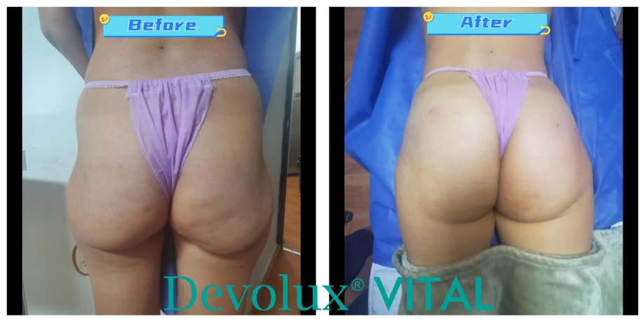 Plla Gluteal Injections before and after