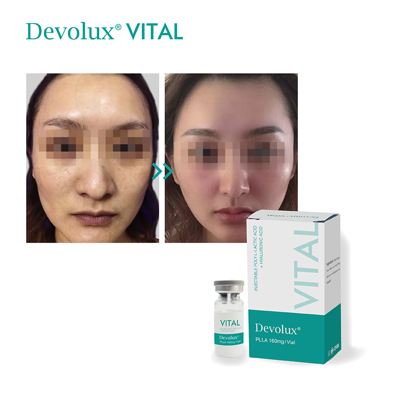 Devolux Plla Filler Injection Before And After