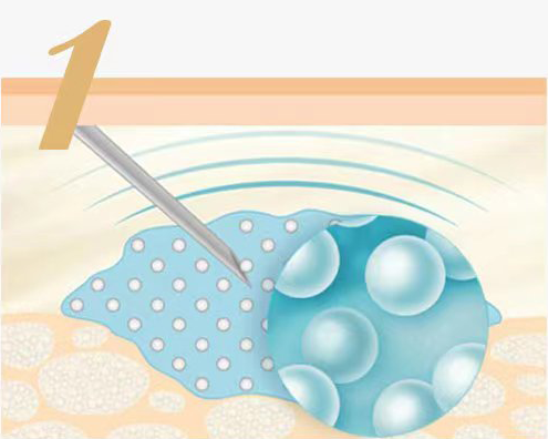 Calcium Hydroxylapatite Fillers Injections work