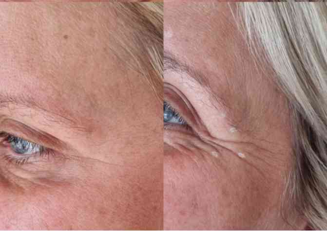 Sotorior crows feet before and after