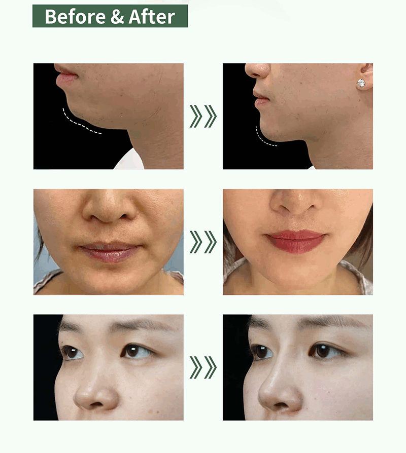 Primefill PMMA Dermal Fillers