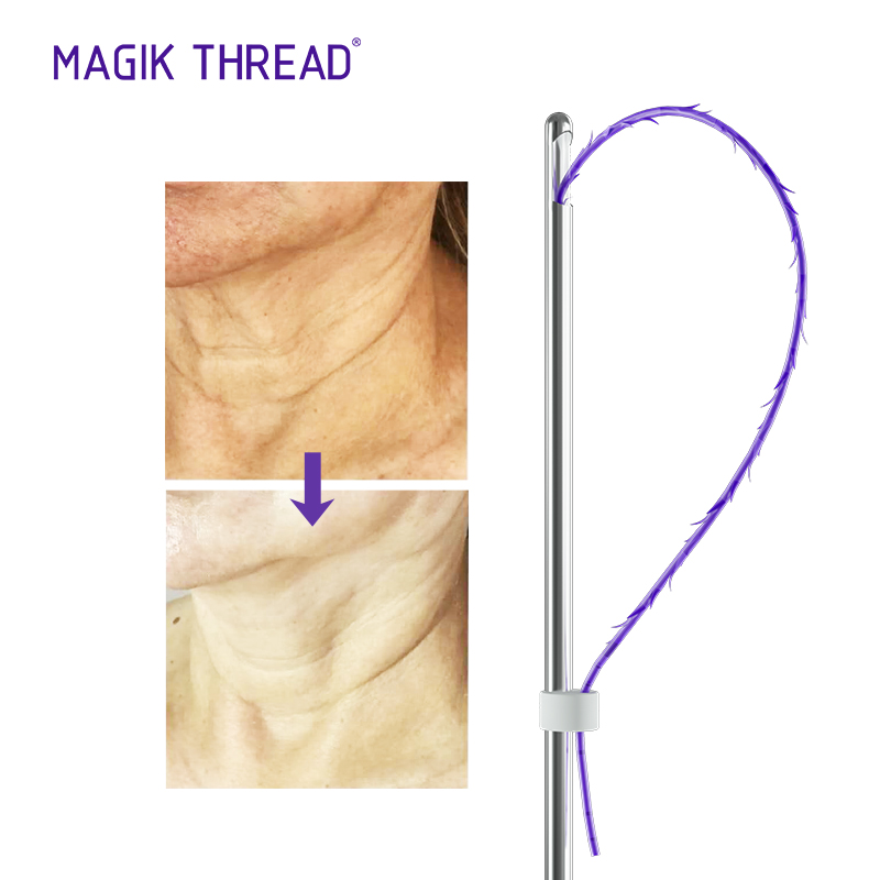 PDO Thread Neck Lift Before And After Comparison