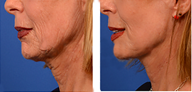 pdo thread lift double chin before and after