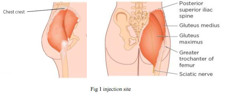Macrolite Hyaluronic Acid Gel Injection Buttocks filler Injection Site