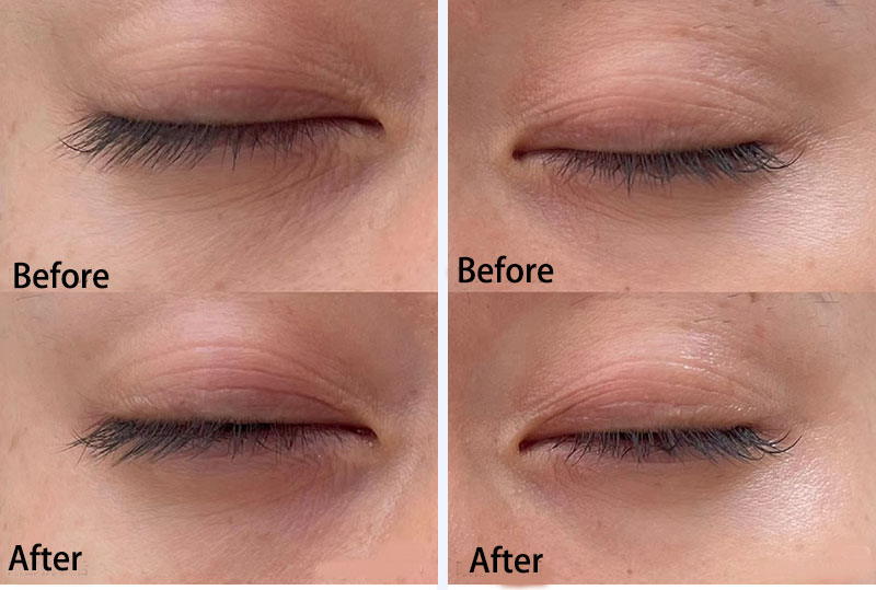 PDRN Eye Treatment Before and After Results (2)