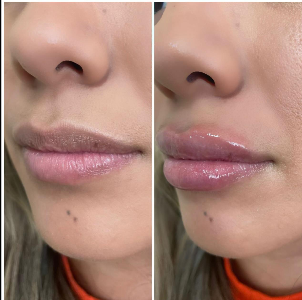 hyaluronic acid filler before and after