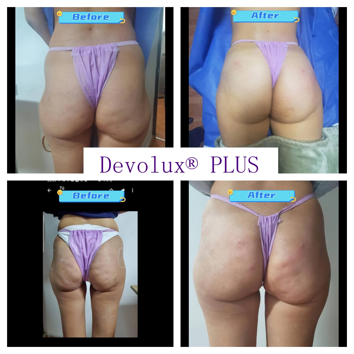 Devolux Plus plla buttock filler before and after