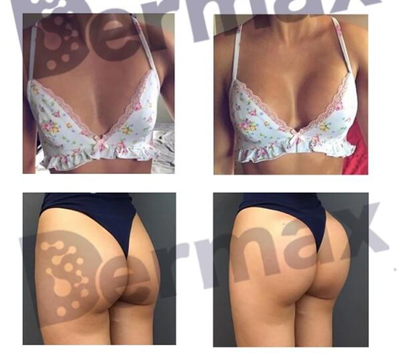 Devolux Plus plla buttock filler before and after