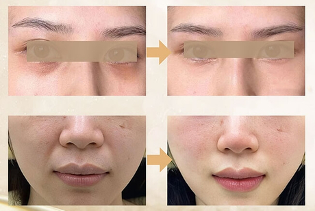 CollaSilk™ Bovine Collagen Implants For Skin