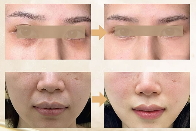 CollaSilk Bovine Collagen Implants For Skin 
