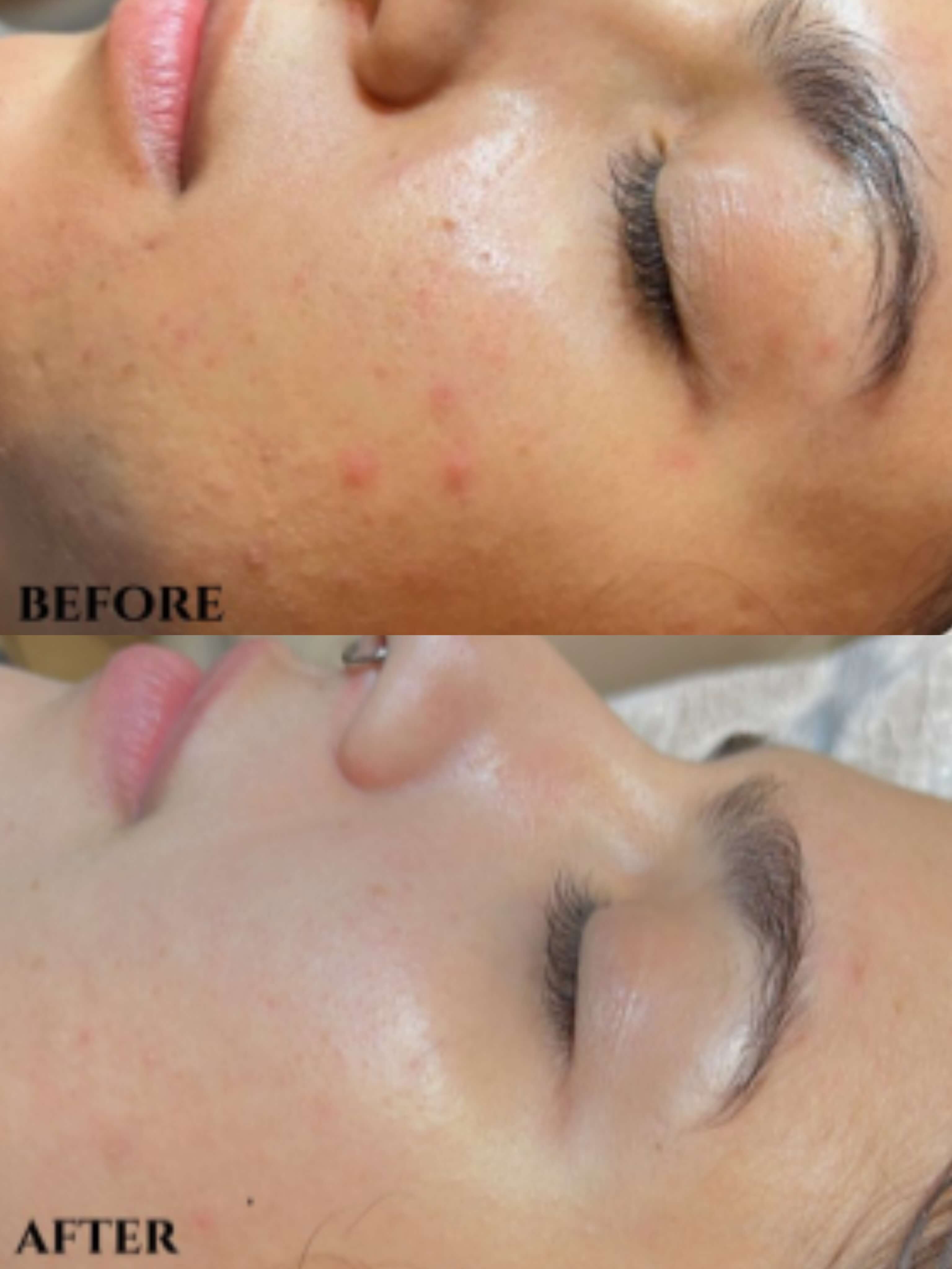 PDRN Skin Benefits 