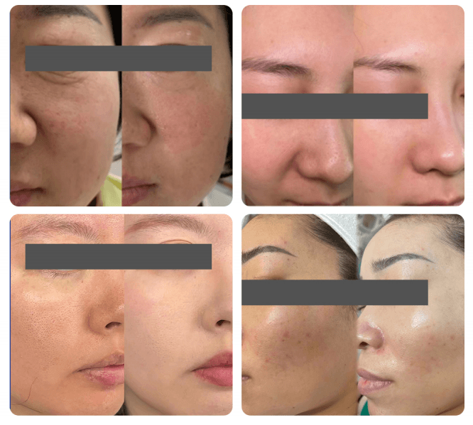 Exosomes for skincare before and after results