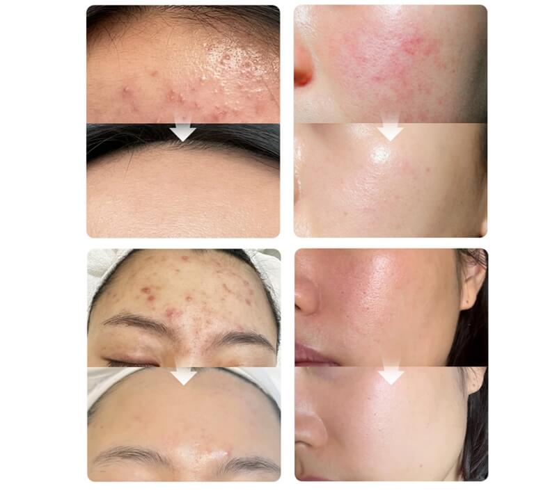 exosome face before and after