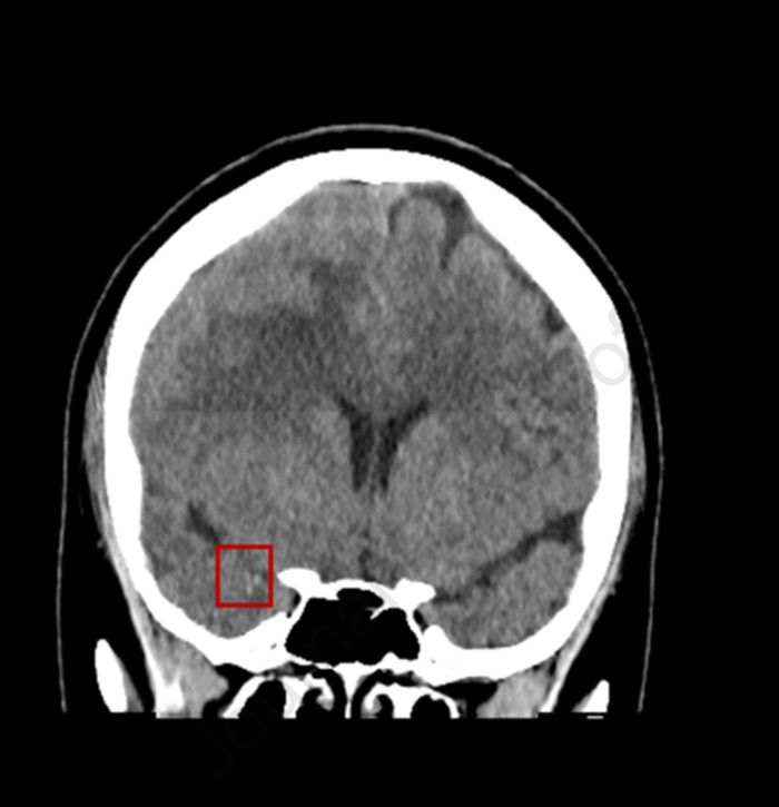 Neck CT showing ICA approximately 4 cm below right mandibular angle