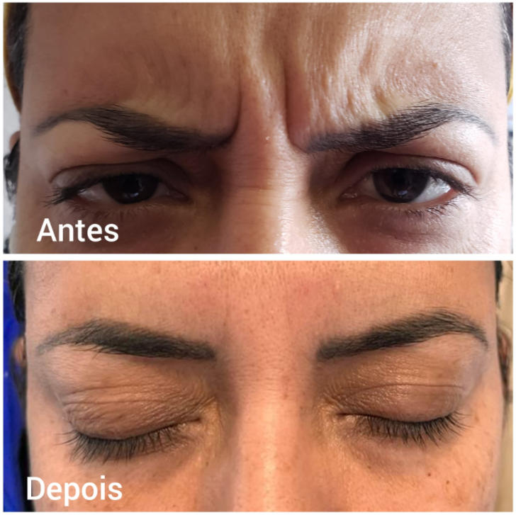 Botulinum Toxin Brow Lift Before and After Photos (2)