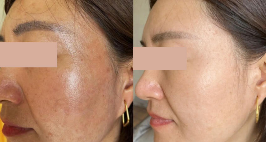 Prejvua ha skin booster before after