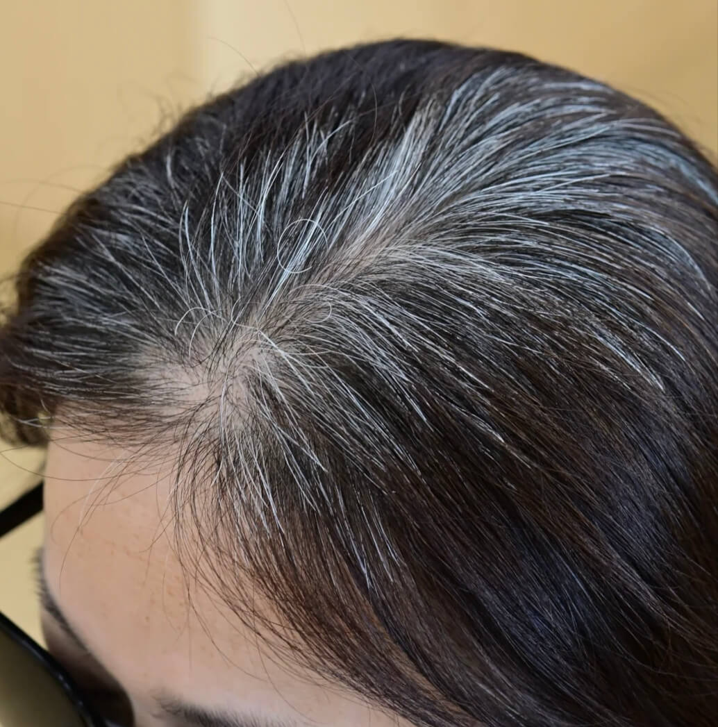 Exosomes Grey Hair: Can They Support Hair Repigmentation?