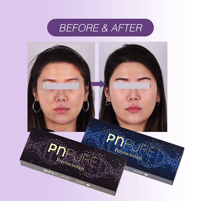 Real PNPURE Polynucleotides Treatment Before and After Photos
