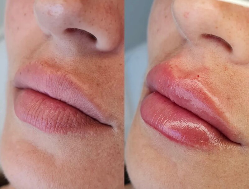 korean lip filler before and after