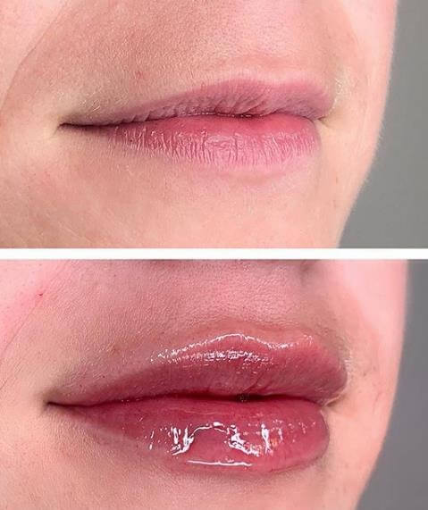 Hyaluronic Acid And Botulinum Toxin Type A Combination Treatment