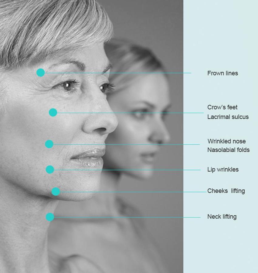100mm Screw Pdo Thread