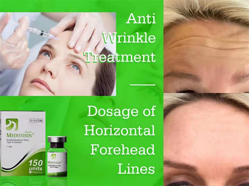 The botulinum dosage of horizontal forehead lines for you.