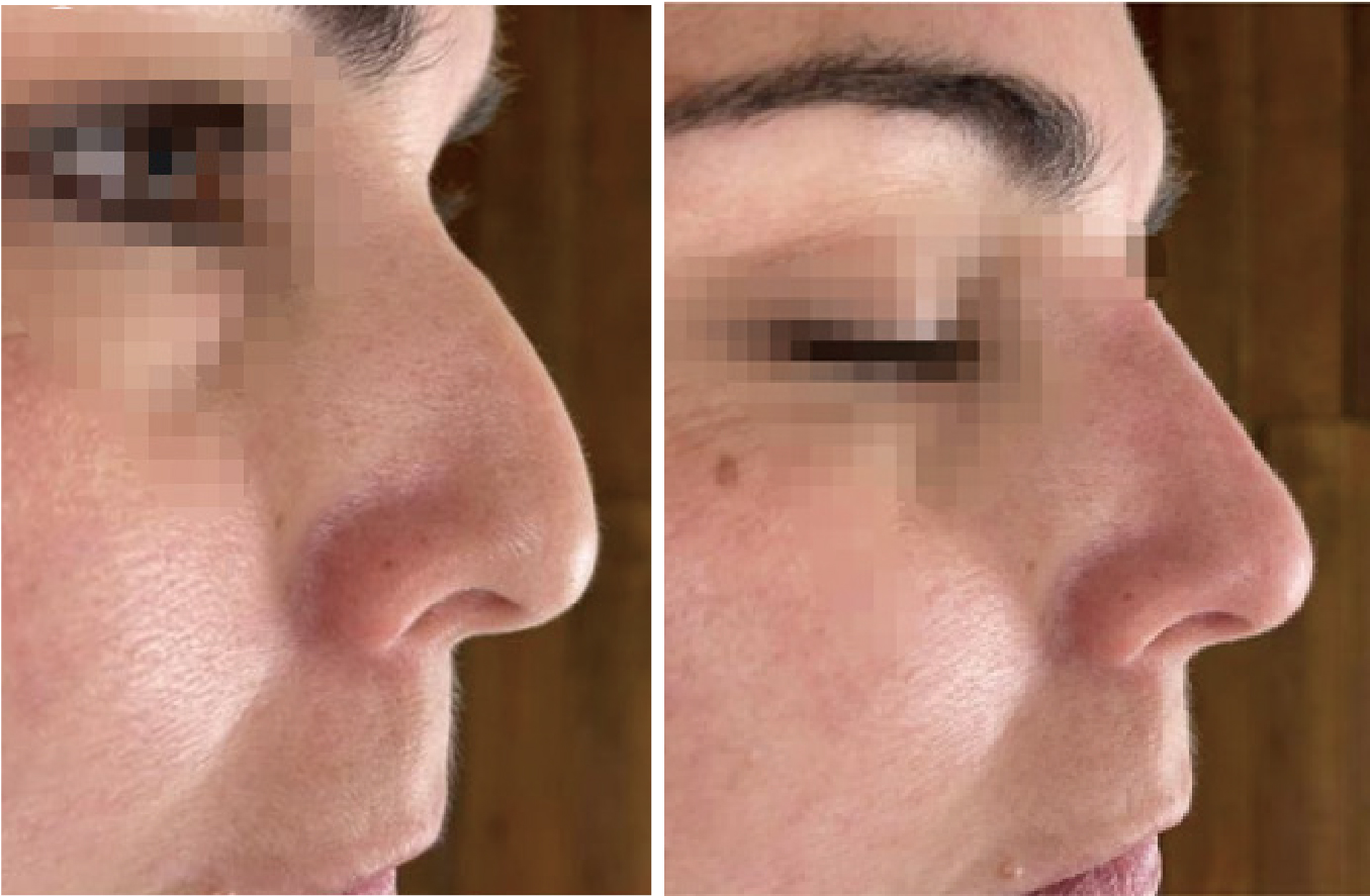 What are the things to note after hyaluronic acid face filling?