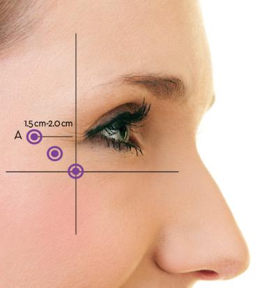 sotorior Crows feet injection pattern