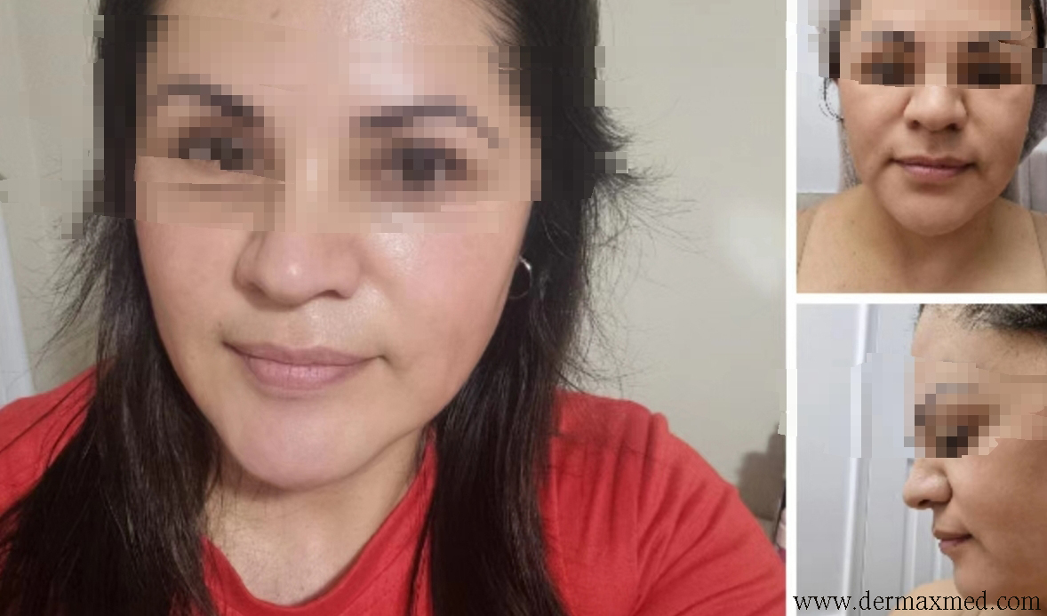 before-&-after-skin-booster-injection-for-perilral-lines