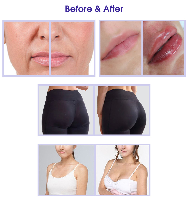 dermal fillers online