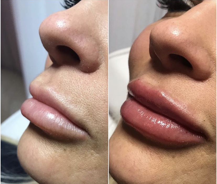 lip filler before and after thin lips