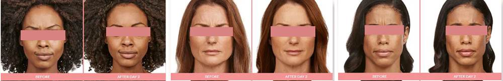 Jeuveau Reviews And Stunning Before And After Pictures