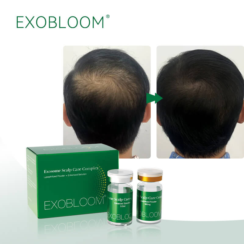 exosomes for hairloss before and after.jpg