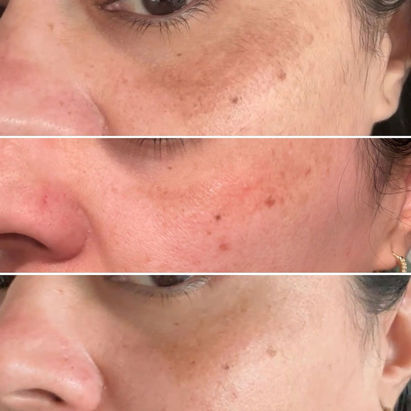 PDRN-Eye-Treatment-Before-and-After-Results-(1)